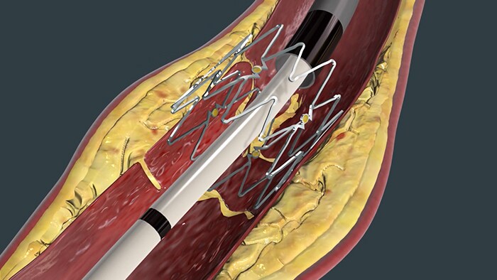 Endovascular System