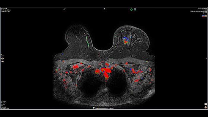 dynacad breast thumbnail