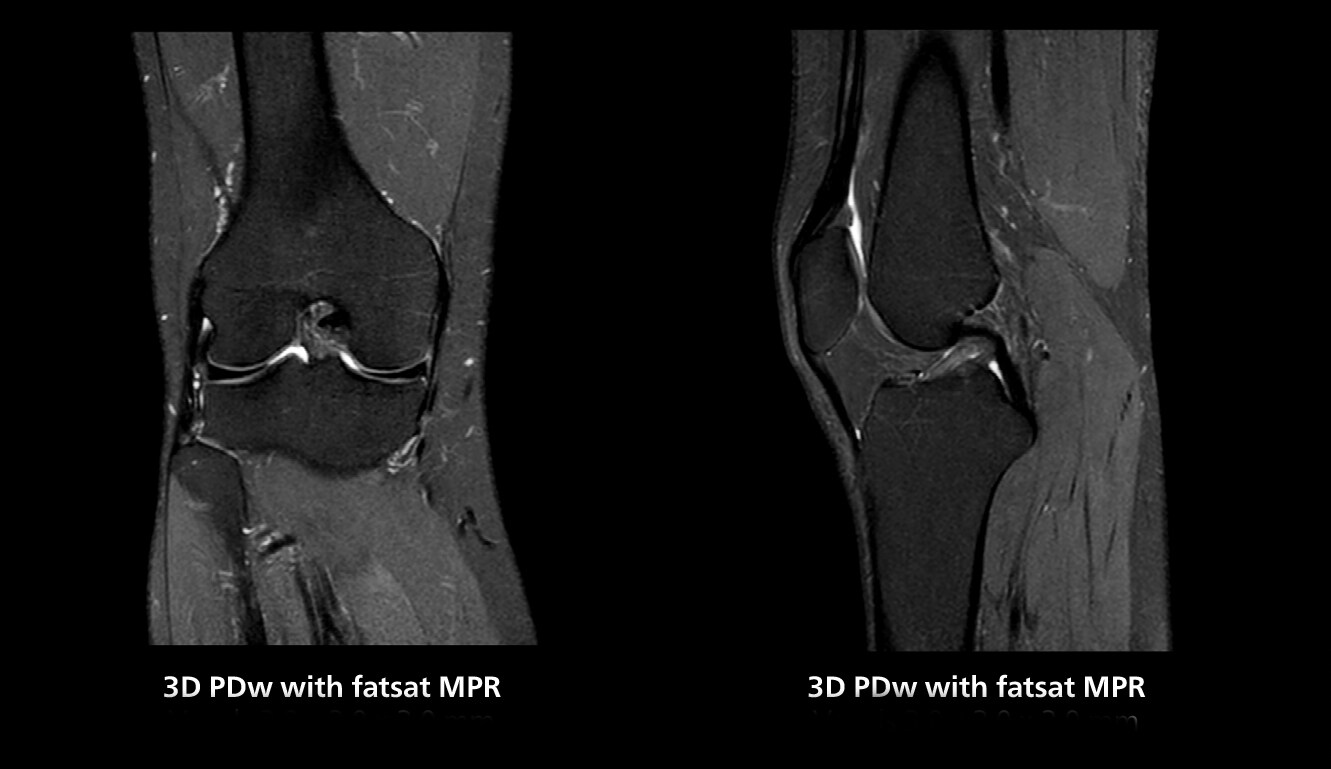 Knee mri two