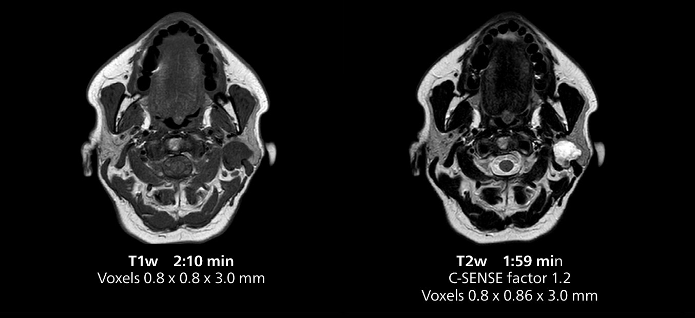 Salivary gland mri one