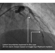 ivus interpretation assessment of lesion length