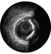 ivus interpretation assessment of lesions