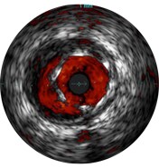 ivus interpretation ivus assessment of stent malapposition