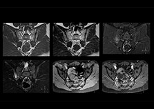 clinical cases 2 sacroiliac joint on multiva