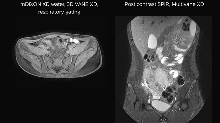 Crohn’s disease in the terminal ileum