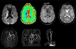 Acute ischemic stroke with ICA and MCA occlusion