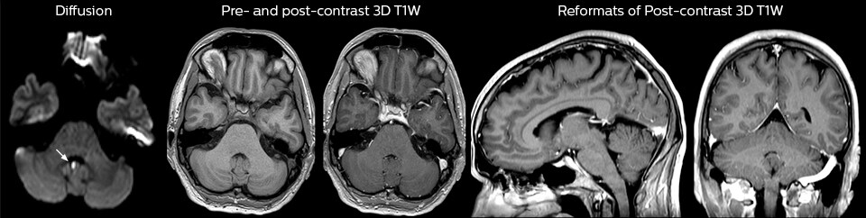 pre and post contrast brain mri in ed