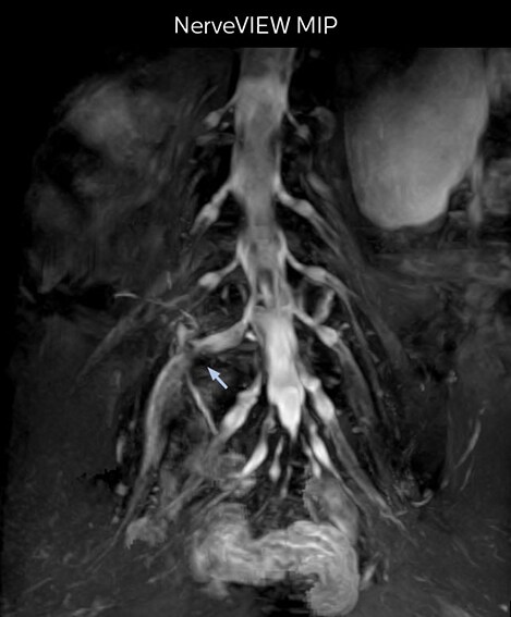 nerveview mip