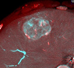 dual view pre embolization 2