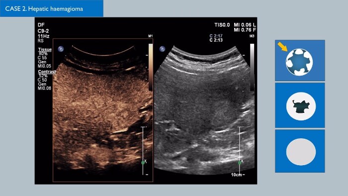 Contrast enhanced ultrasound video 