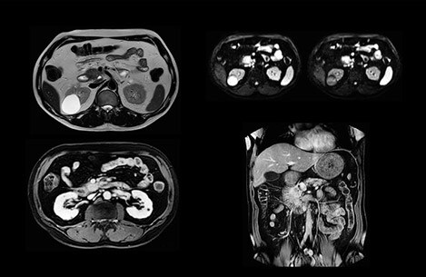 liver mri pancreas cancer image 1