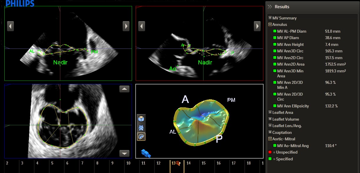 Mitral Valve Navigator